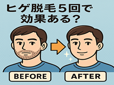 脱毛5回 髭 青髭は消えるのか？脱毛男子のリアル口コミ集